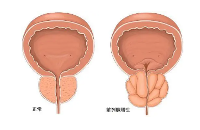 兩性健康 | 對(duì)于女性來(lái)說(shuō)，最怕男人得什么病？